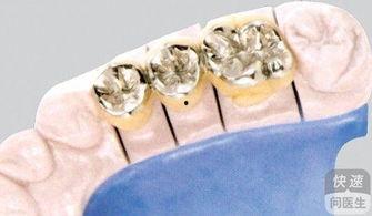 补牙打桩视频,揭秘补牙打桩全过程